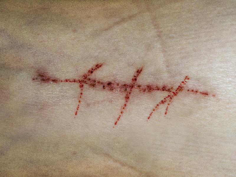 Wound Skin Scar Image